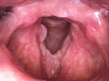 laryngeal papillomatosis natural treatment)