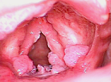laryngeal papillomatosis natural treatment)